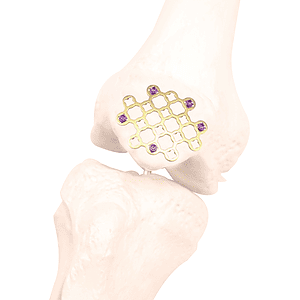 Variable Angle Patella Locking Plate