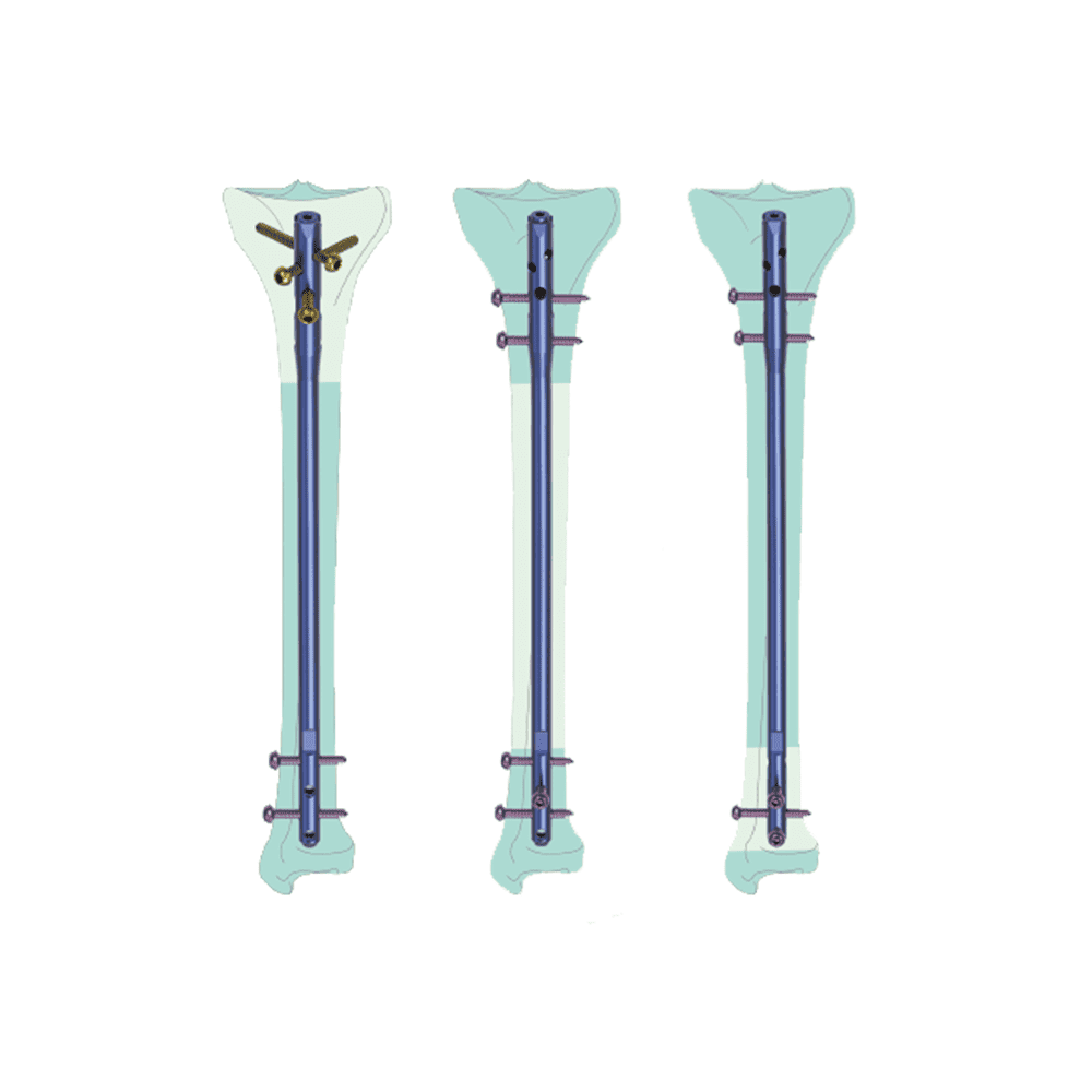 KTO Tibial Intramedullary Nail System