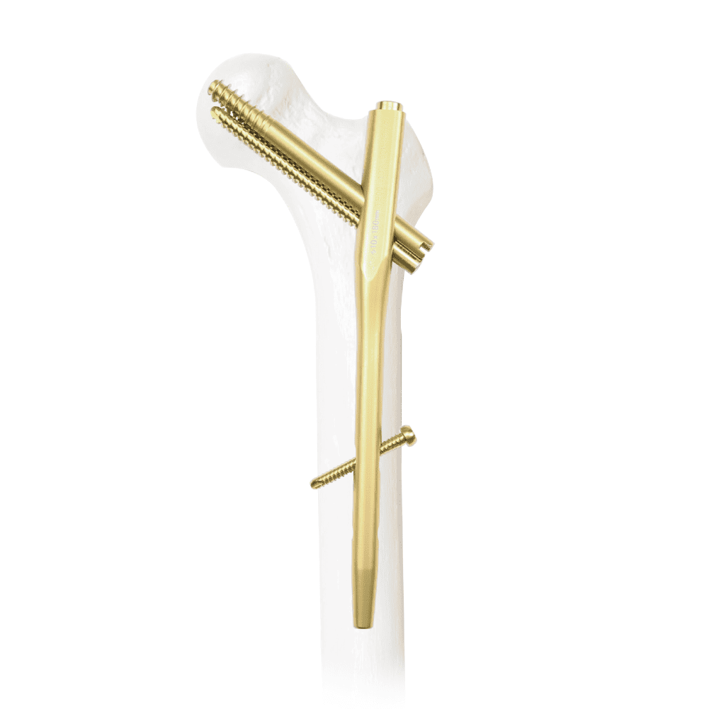 Sliding Compression Gamma Nail